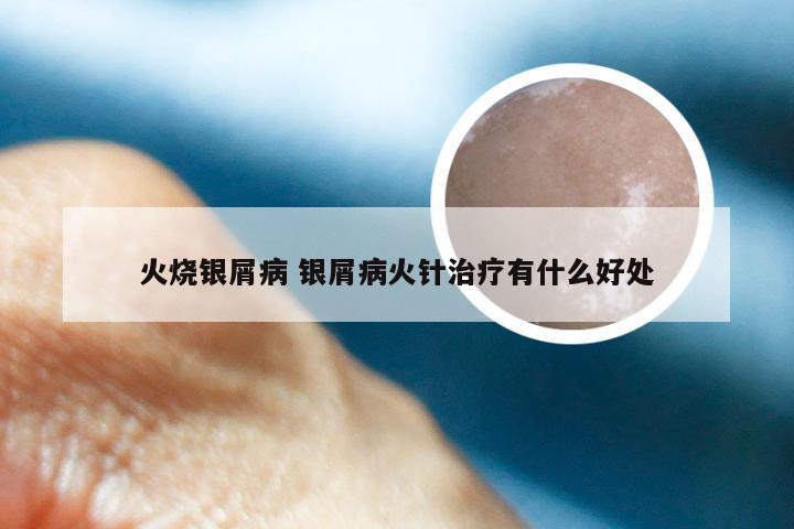 火烧银屑病 银屑病火针治疗有什么好处