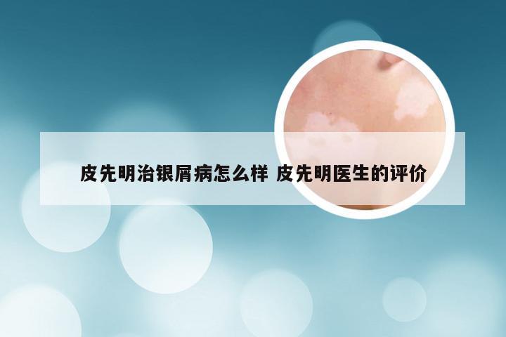皮先明治银屑病怎么样 皮先明医生的评价