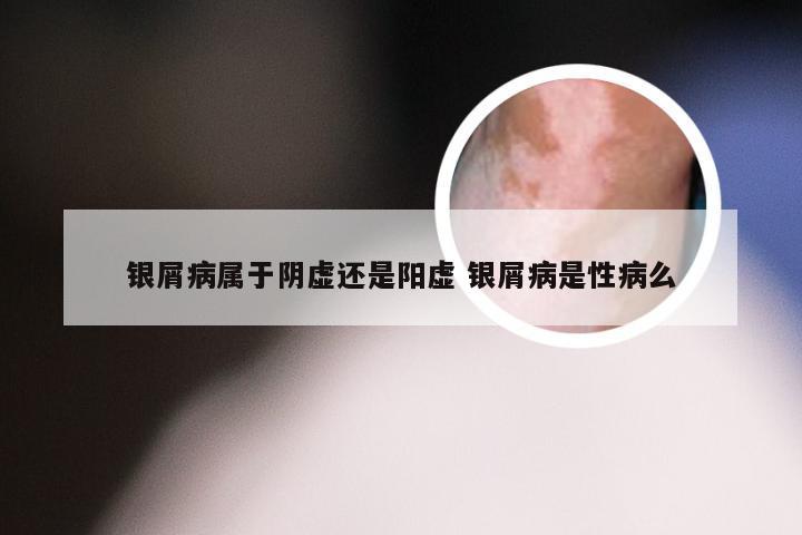 银屑病属于阴虚还是阳虚 银屑病是性病么