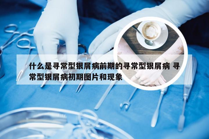 什么是寻常型银屑病前期的寻常型银屑病 寻常型银屑病初期图片和现象