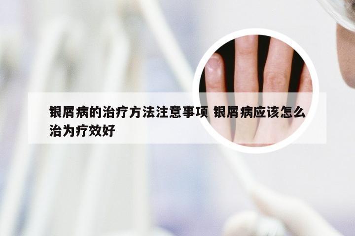银屑病的治疗方法注意事项 银屑病应该怎么治为疗效好
