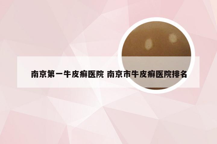 南京第一牛皮癣医院 南京市牛皮癣医院排名