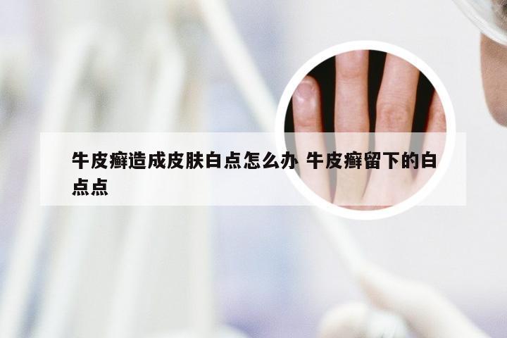 牛皮癣造成皮肤白点怎么办 牛皮癣留下的白点点
