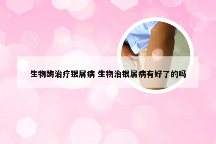 生物酶治疗银屑病 生物治银屑病有好了的吗