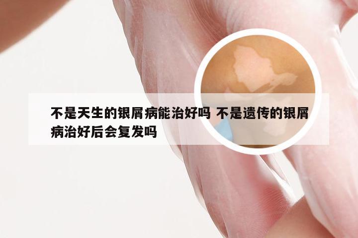 不是天生的银屑病能治好吗 不是遗传的银屑病治好后会复发吗