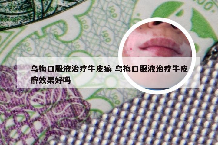 乌梅口服液治疗牛皮癣 乌梅口服液治疗牛皮癣效果好吗