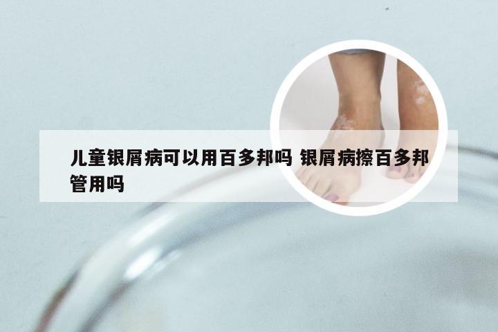 儿童银屑病可以用百多邦吗 银屑病擦百多邦管用吗