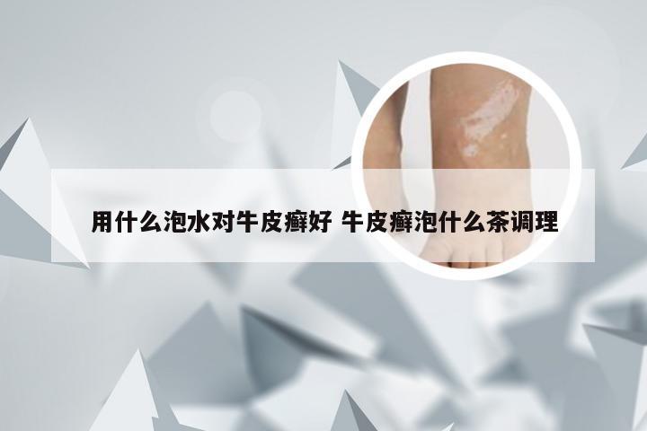 用什么泡水对牛皮癣好 牛皮癣泡什么茶调理