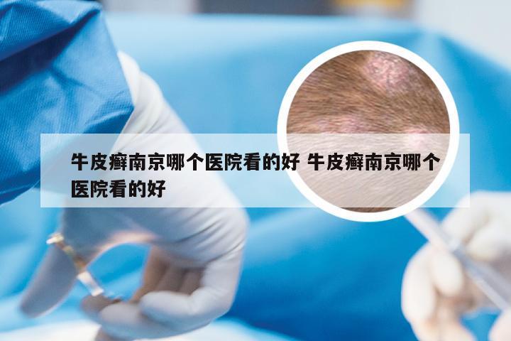 牛皮癣南京哪个医院看的好 牛皮癣南京哪个医院看的好