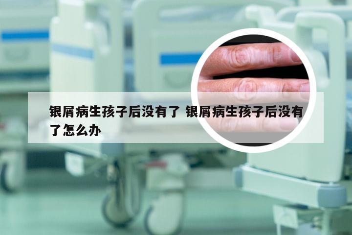 银屑病生孩子后没有了 银屑病生孩子后没有了怎么办