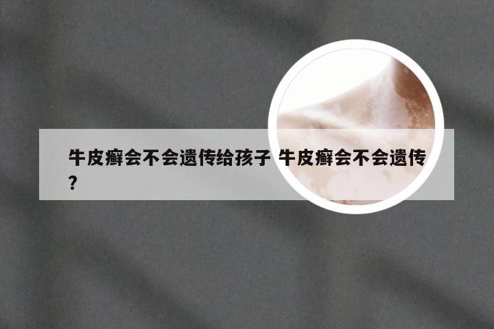 牛皮癣会不会遗传给孩子 牛皮癣会不会遗传?