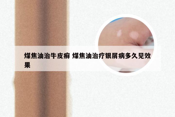 煤焦油治牛皮癣 煤焦油治疗银屑病多久见效果