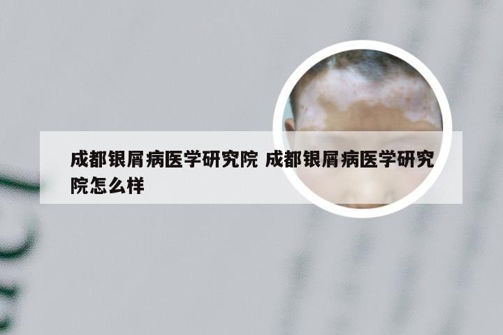 成都银屑病医学研究院 成都银屑病医学研究院怎么样
