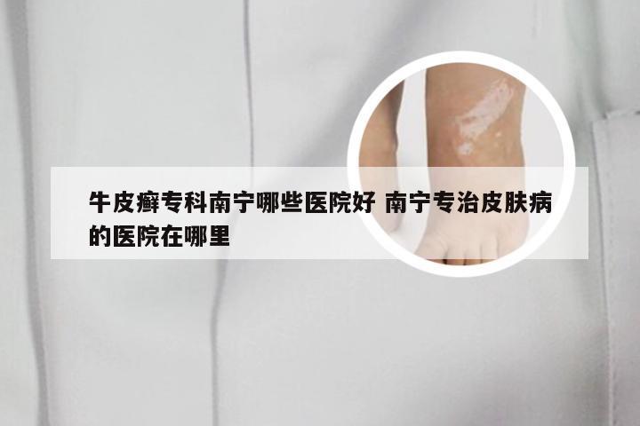 牛皮癣专科南宁哪些医院好 南宁专治皮肤病的医院在哪里