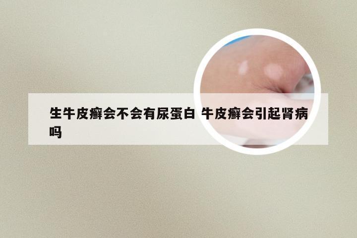 生牛皮癣会不会有尿蛋白 牛皮癣会引起肾病吗