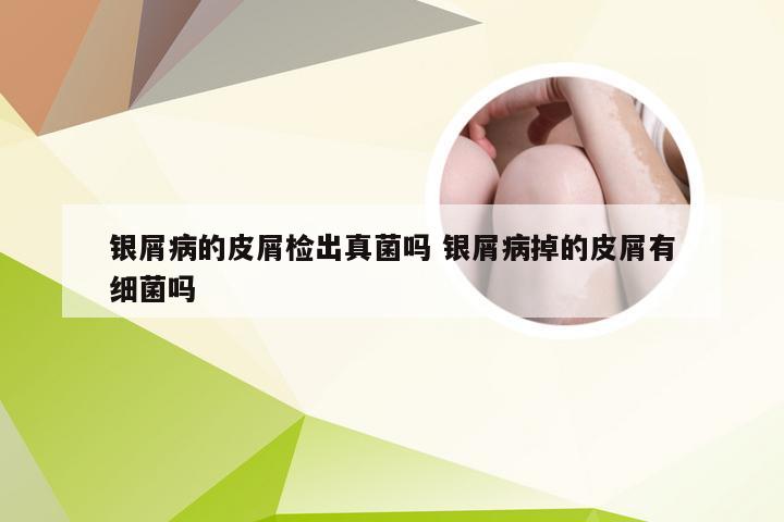银屑病的皮屑检出真菌吗 银屑病掉的皮屑有细菌吗