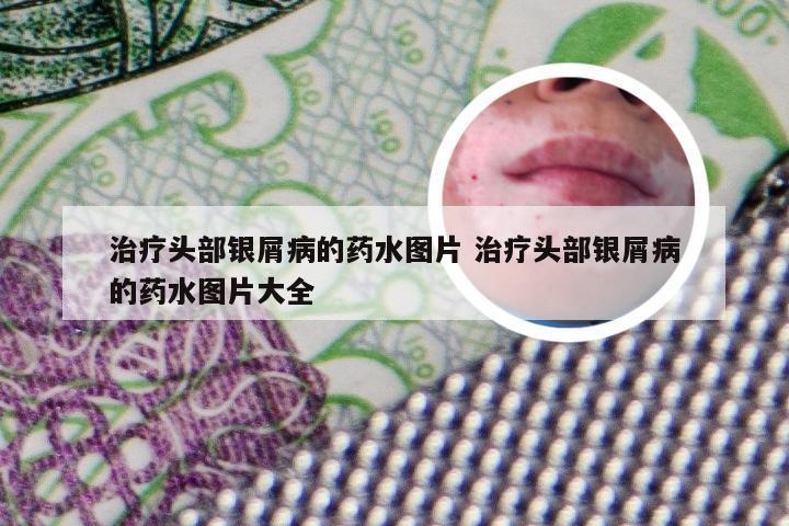 治疗头部银屑病的药水图片 治疗头部银屑病的药水图片大全