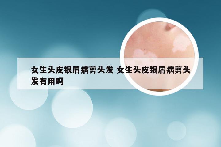 女生头皮银屑病剪头发 女生头皮银屑病剪头发有用吗