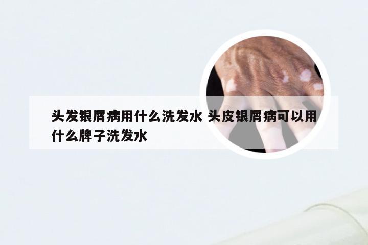 头发银屑病用什么洗发水 头皮银屑病可以用什么牌子洗发水