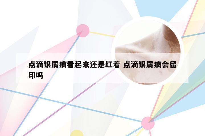 点滴银屑病看起来还是红着 点滴银屑病会留印吗