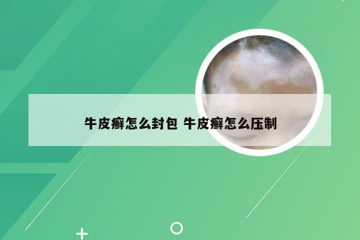 牛皮癣怎么封包 牛皮癣怎么压制