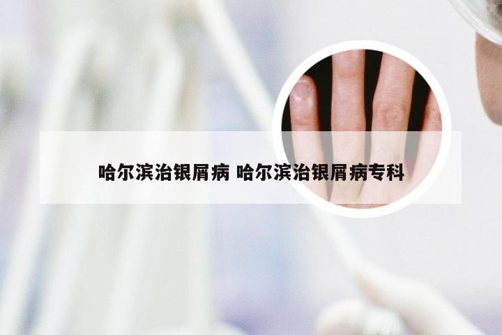 哈尔滨治银屑病 哈尔滨治银屑病专科