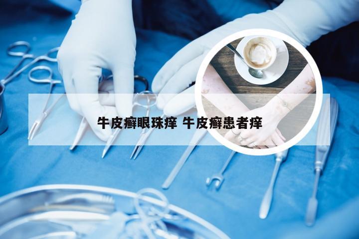 牛皮癣眼珠痒 牛皮癣患者痒