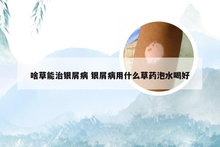 啥草能治银屑病 银屑病用什么草药泡水喝好