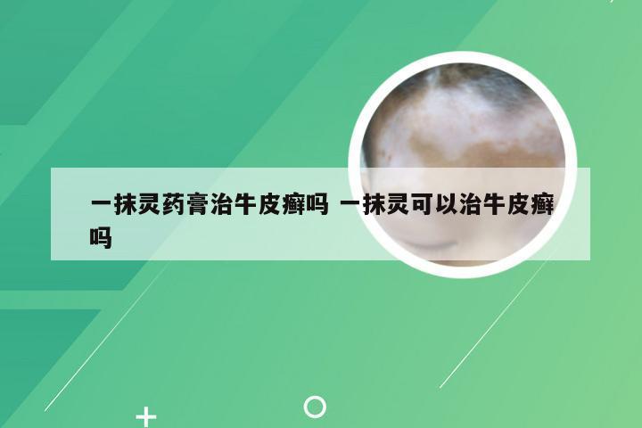 一抹灵药膏治牛皮癣吗 一抹灵可以治牛皮癣吗