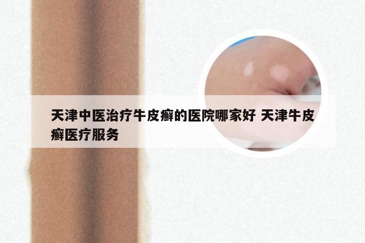 天津中医治疗牛皮癣的医院哪家好 天津牛皮癣医疗服务