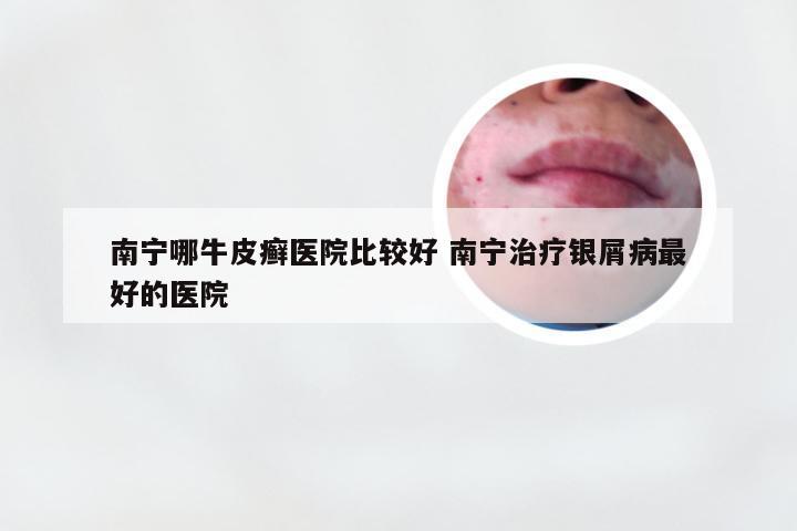 南宁哪牛皮癣医院比较好 南宁治疗银屑病最好的医院