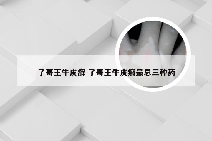 了哥王牛皮癣 了哥王牛皮癣最忌三种药
