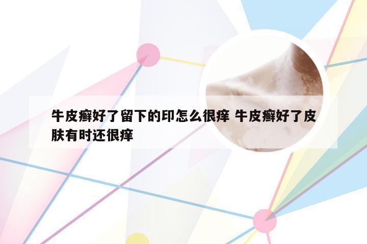 牛皮癣好了留下的印怎么很痒 牛皮癣好了皮肤有时还很痒