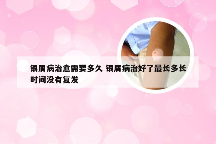 银屑病治愈需要多久 银屑病治好了最长多长时间没有复发