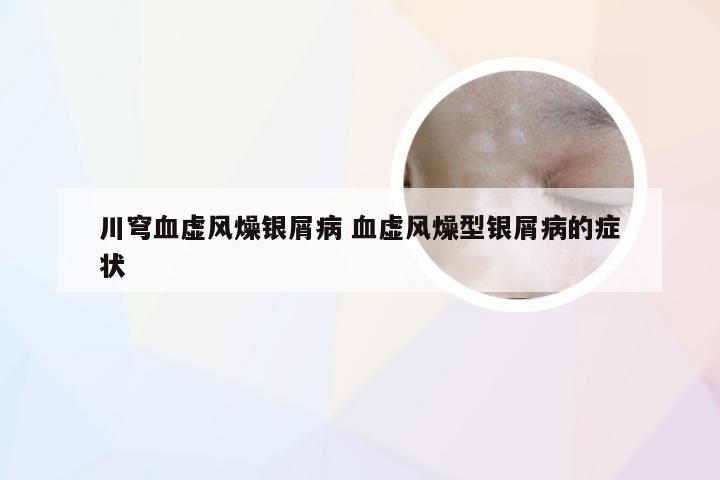 川穹血虚风燥银屑病 血虚风燥型银屑病的症状