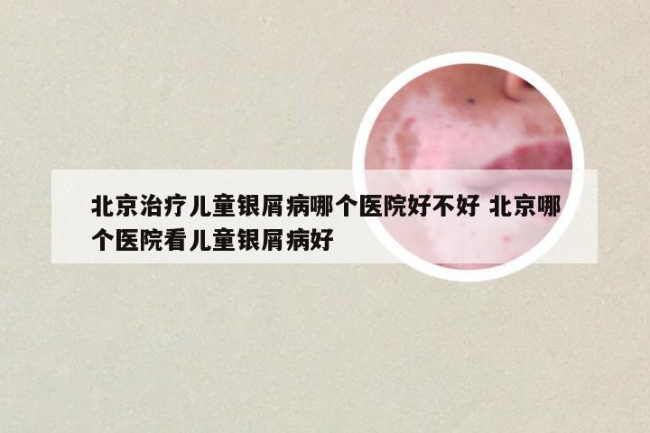 北京治疗儿童银屑病哪个医院好不好 北京哪个医院看儿童银屑病好