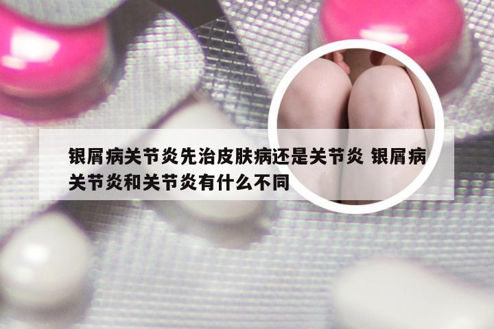 银屑病关节炎先治皮肤病还是关节炎 银屑病关节炎和关节炎有什么不同