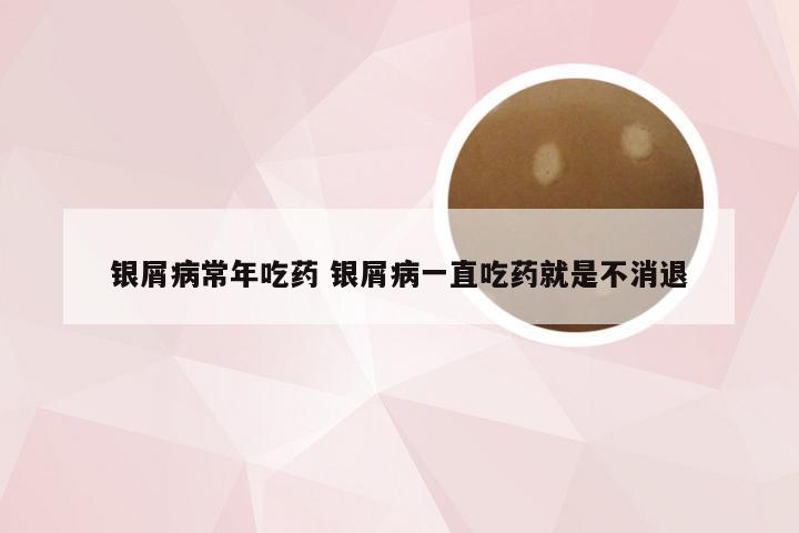 银屑病常年吃药 银屑病一直吃药就是不消退