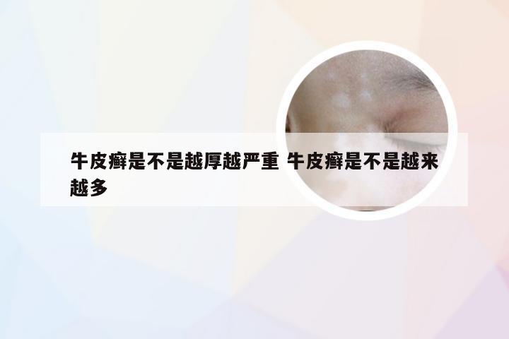 牛皮癣是不是越厚越严重 牛皮癣是不是越来越多