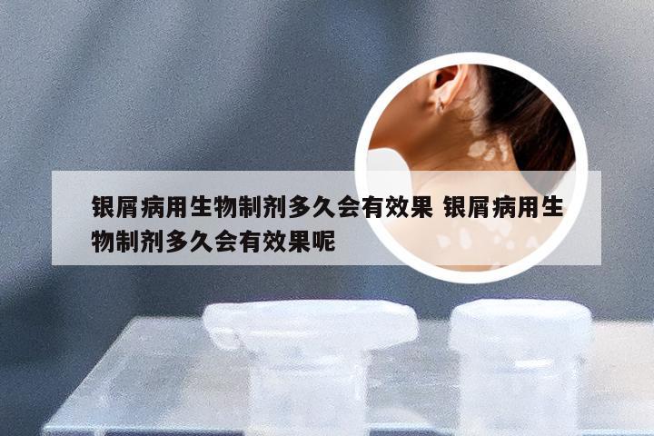 银屑病用生物制剂多久会有效果 银屑病用生物制剂多久会有效果呢