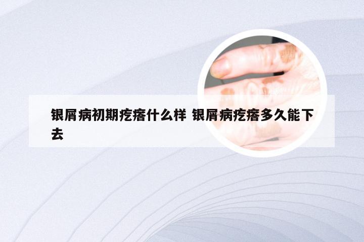 银屑病初期疙瘩什么样 银屑病疙瘩多久能下去