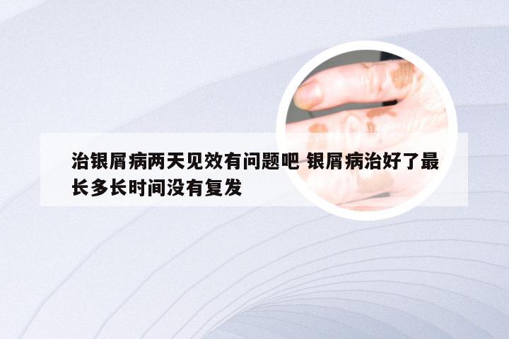 治银屑病两天见效有问题吧 银屑病治好了最长多长时间没有复发