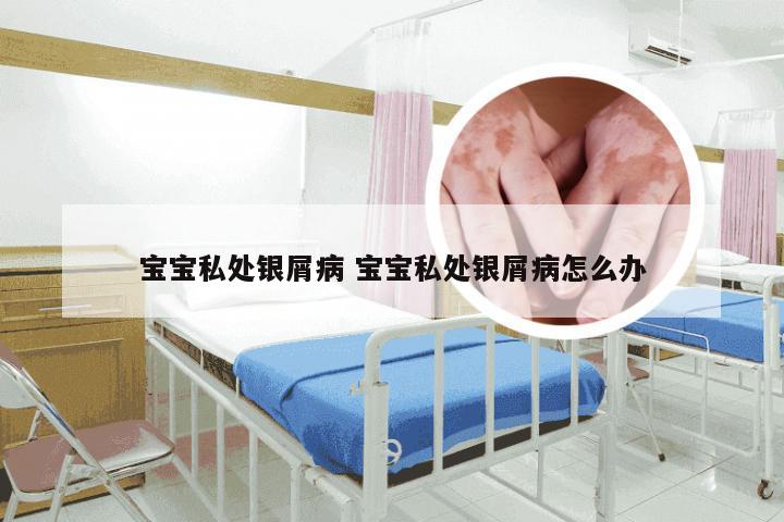 宝宝私处银屑病 宝宝私处银屑病怎么办