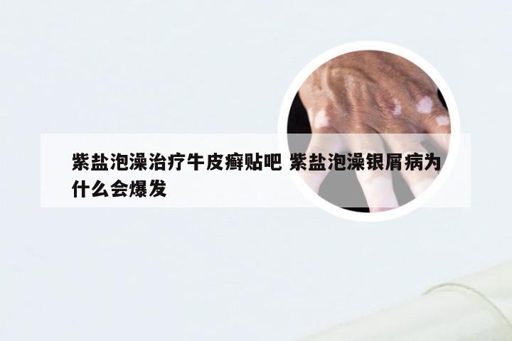 紫盐泡澡治疗牛皮癣贴吧 紫盐泡澡银屑病为什么会爆发