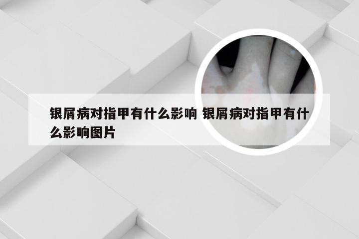 银屑病对指甲有什么影响 银屑病对指甲有什么影响图片