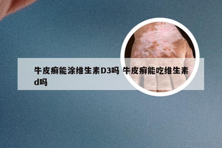 牛皮癣能涂维生素D3吗 牛皮癣能吃维生素d吗