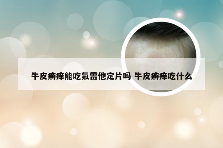 牛皮癣痒能吃氟雷他定片吗 牛皮癣痒吃什么
