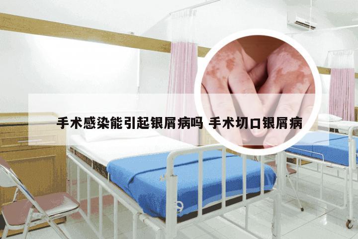 手术感染能引起银屑病吗 手术切口银屑病