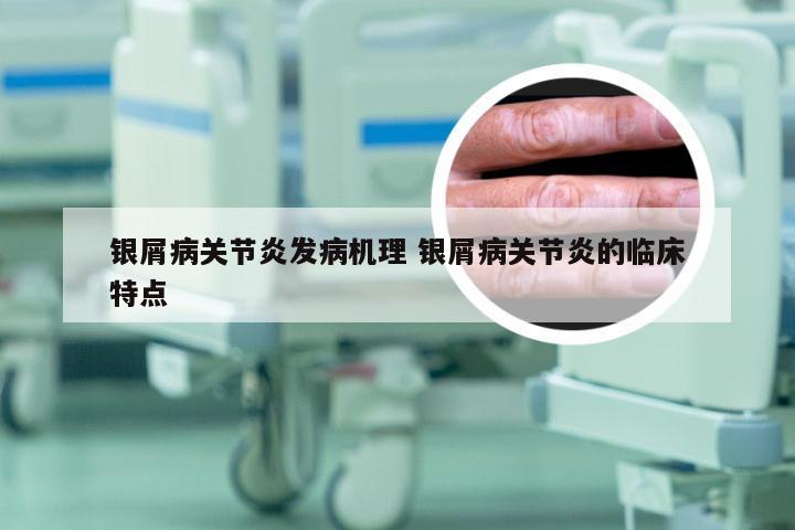 银屑病关节炎发病机理 银屑病关节炎的临床特点