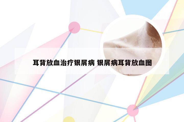 耳背放血治疗银屑病 银屑病耳背放血图